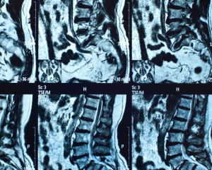 Should You Get an MRI Scan for a Low Back Injury?